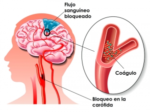 Qu&eacute; es un ictus: s&iacute;ntomas, causas y qu&eacute; secuelas deja a quien lo sufre.